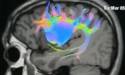 URUGUAY: LOGRAN CON ÉXITO PRIMERA NEUROCIRUGÍA DE UN TUMOR CEREBRAL CON MAPEO DE LA COGNICIÓN SOCIAL