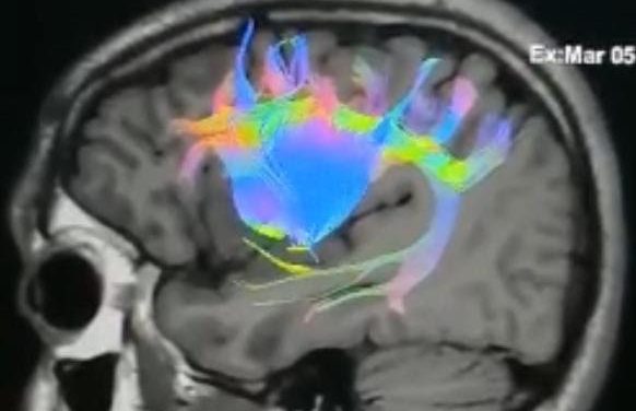 URUGUAY: LOGRAN CON ÉXITO PRIMERA NEUROCIRUGÍA DE UN TUMOR CEREBRAL CON MAPEO DE LA COGNICIÓN SOCIAL