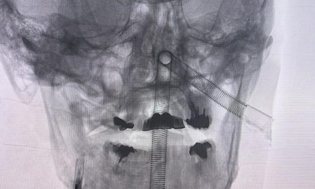 Inédito en Uruguay: equipo del Hospital Maciel realizó exitosamente una cirugía de altísima complejidad