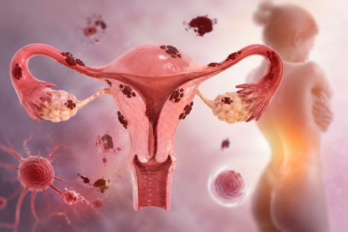 Endometriosis