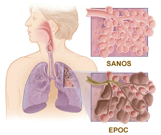 Conmemoración del Día Mundial de la EPOC (Enfermedad Pulmonar Obstructiva Crónica)