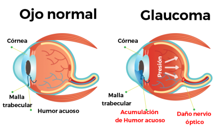 Semana Mundial del Glaucoma: Jornada de Concientización