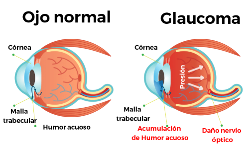 glaucoma