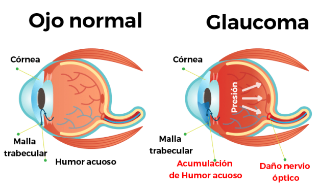 Semana Mundial del Glaucoma: Jornada de Concientización